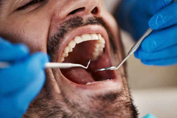 Best Emergency Wisdom Teeth Removal in Cashton, WI