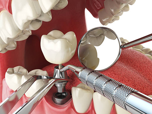 Best Urgent Care for Lost Fillings or Crowns in Cashton, WI